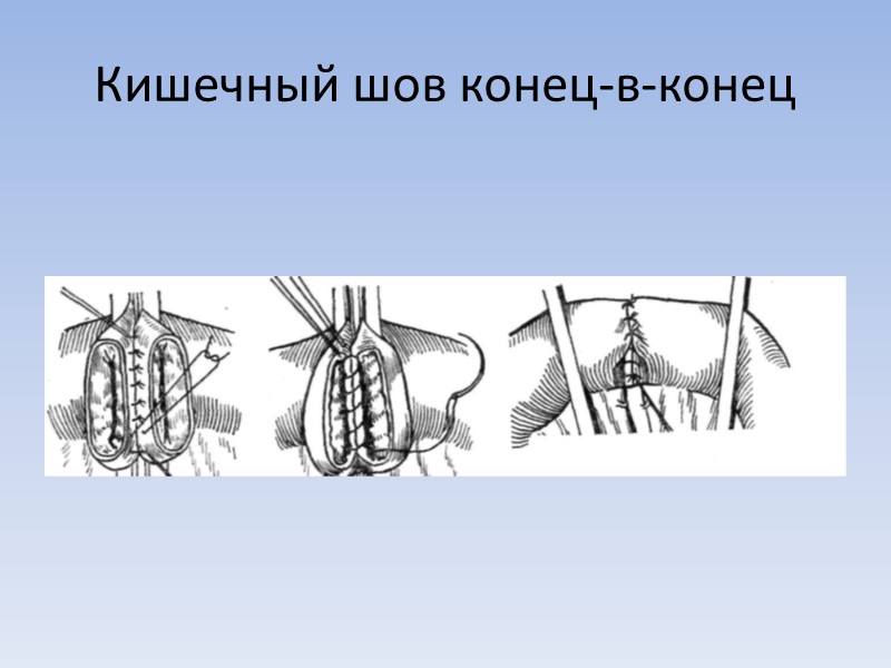 Кишечный шов конец-в-конец